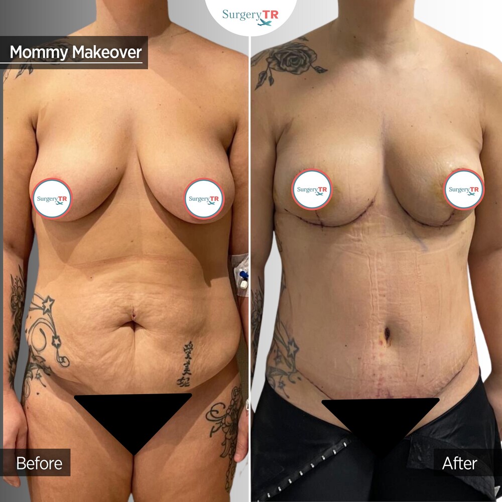 Before and After Result